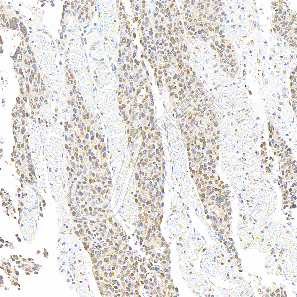 2 K133015_P38_S98023051605_d1500_H gastric carcinoma_20.0x_IHC.jpg